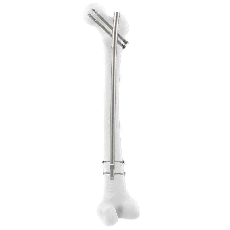 Універсальний (проксимальний) стегновий стрижень ZFN (Довгий) Zimed